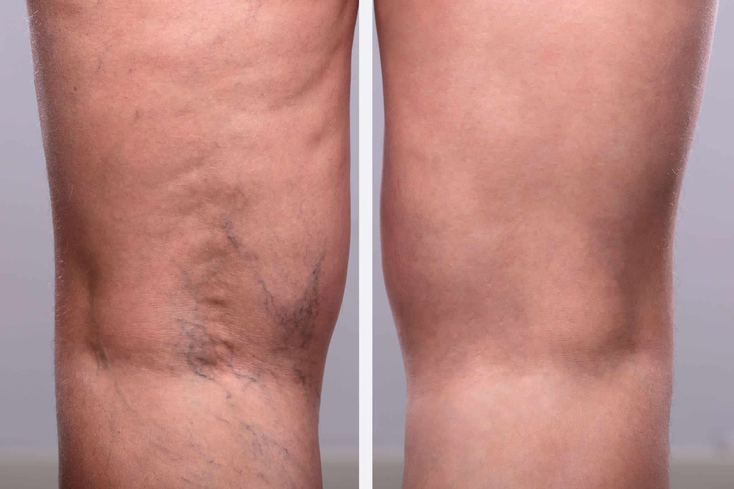 a,person,knee's,with,varicose,veins,and,capillaries,before,and